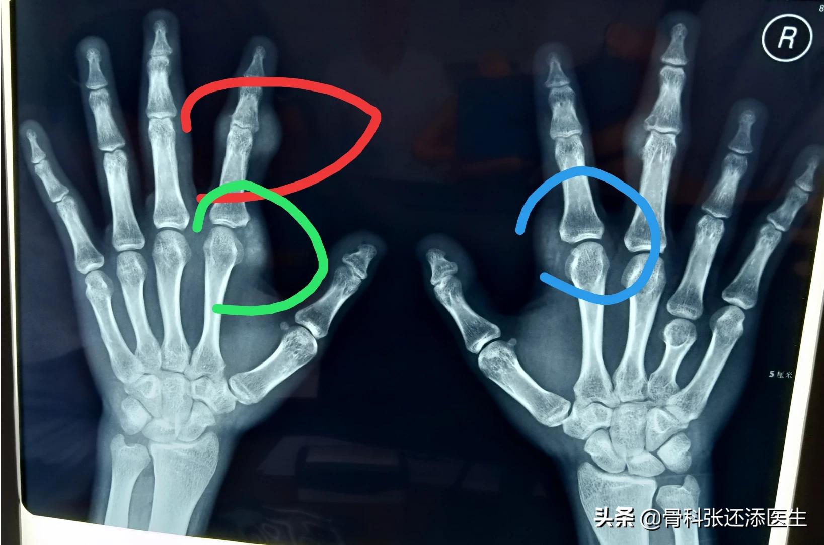 医生从我体内取出一盆石头，都是痛风惹的祸！痛风石怎么治疗？