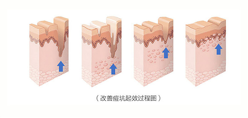 皮肤科医生都在用的护肤品，冻干粉到底是什么？痘印泛红克星