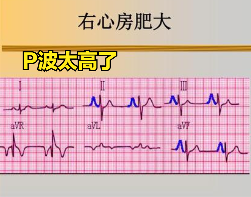 普通人怎么看心电图？医生说：把图上的线条和心脏的跳动结合起来