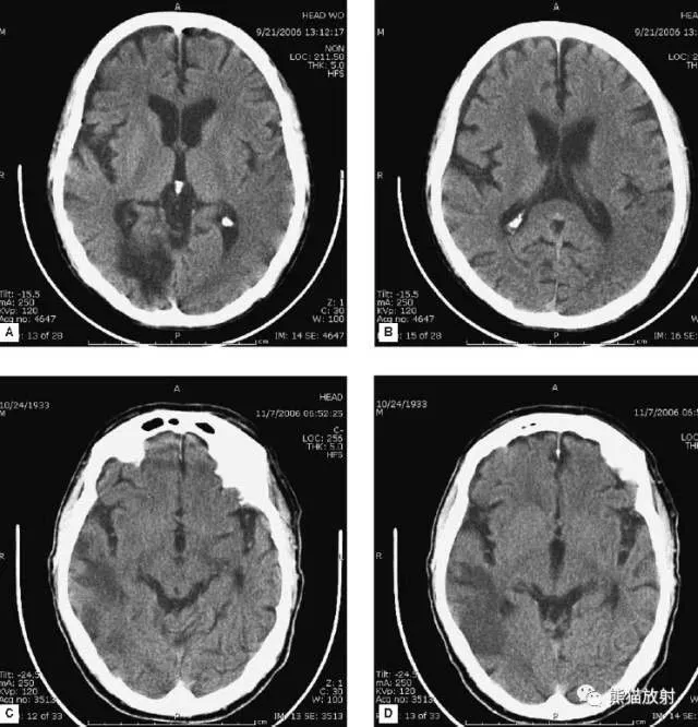 简明又详细的头部CT读片详解，收藏