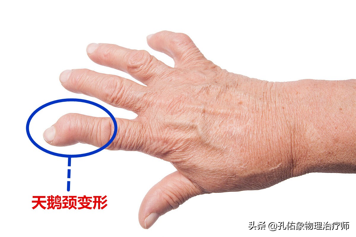 手背疼痛怎么回事(手指发胀)