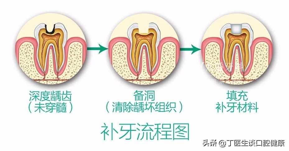 完全不懂，补牙材料这么多，到底怎么选？