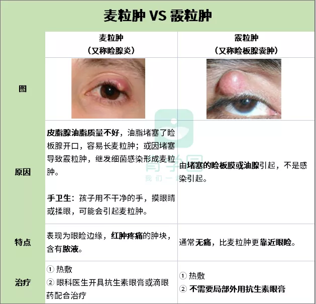 html霰粒肿和麦粒肿是两种不同的眼部疾病,一开始症状相似,但霰粒肿的