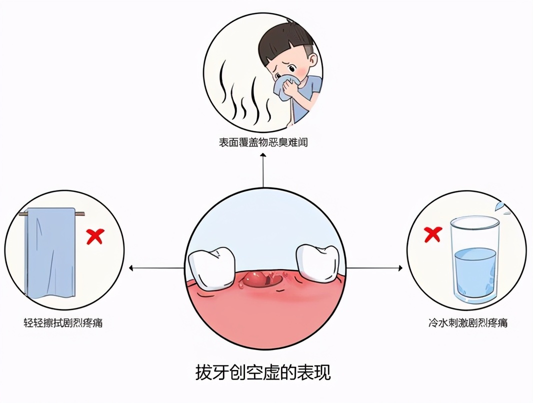 拔智齿后患上干槽症,是种什么体验?看看过来人怎么说