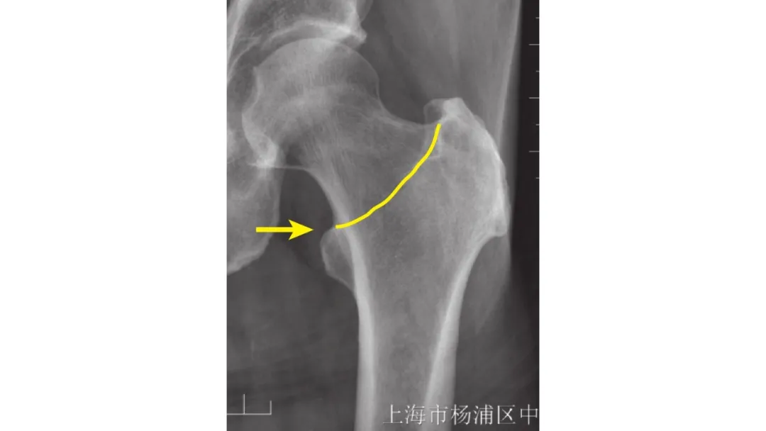 同时累及同侧股骨颈与转子间两个解剖区域的骨折类型与研究进展