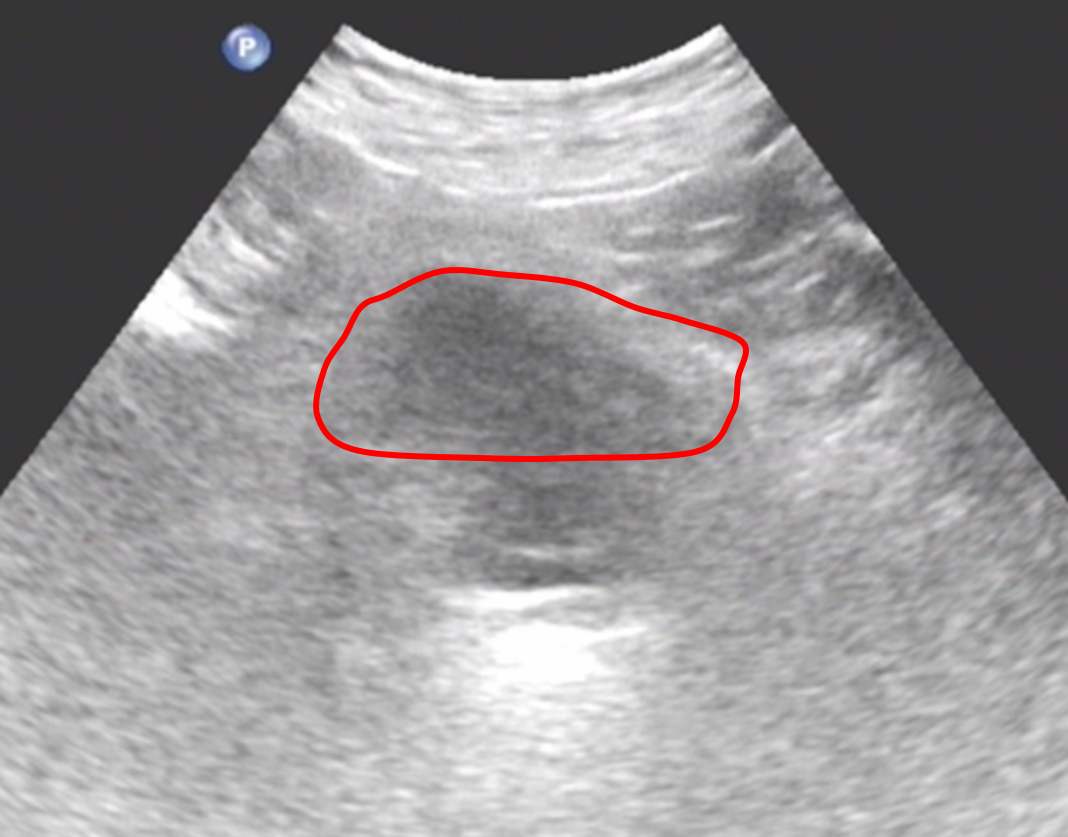 没有无缘无故的憋尿,只有充盈不起来的膀胱