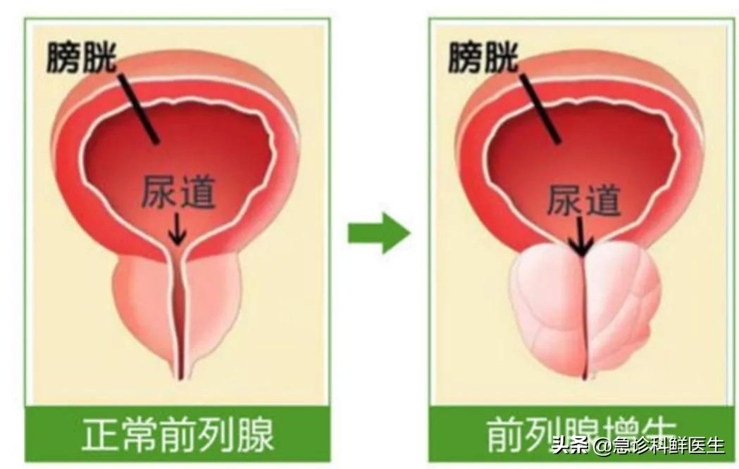 前列腺增生治疗方法及应对措施