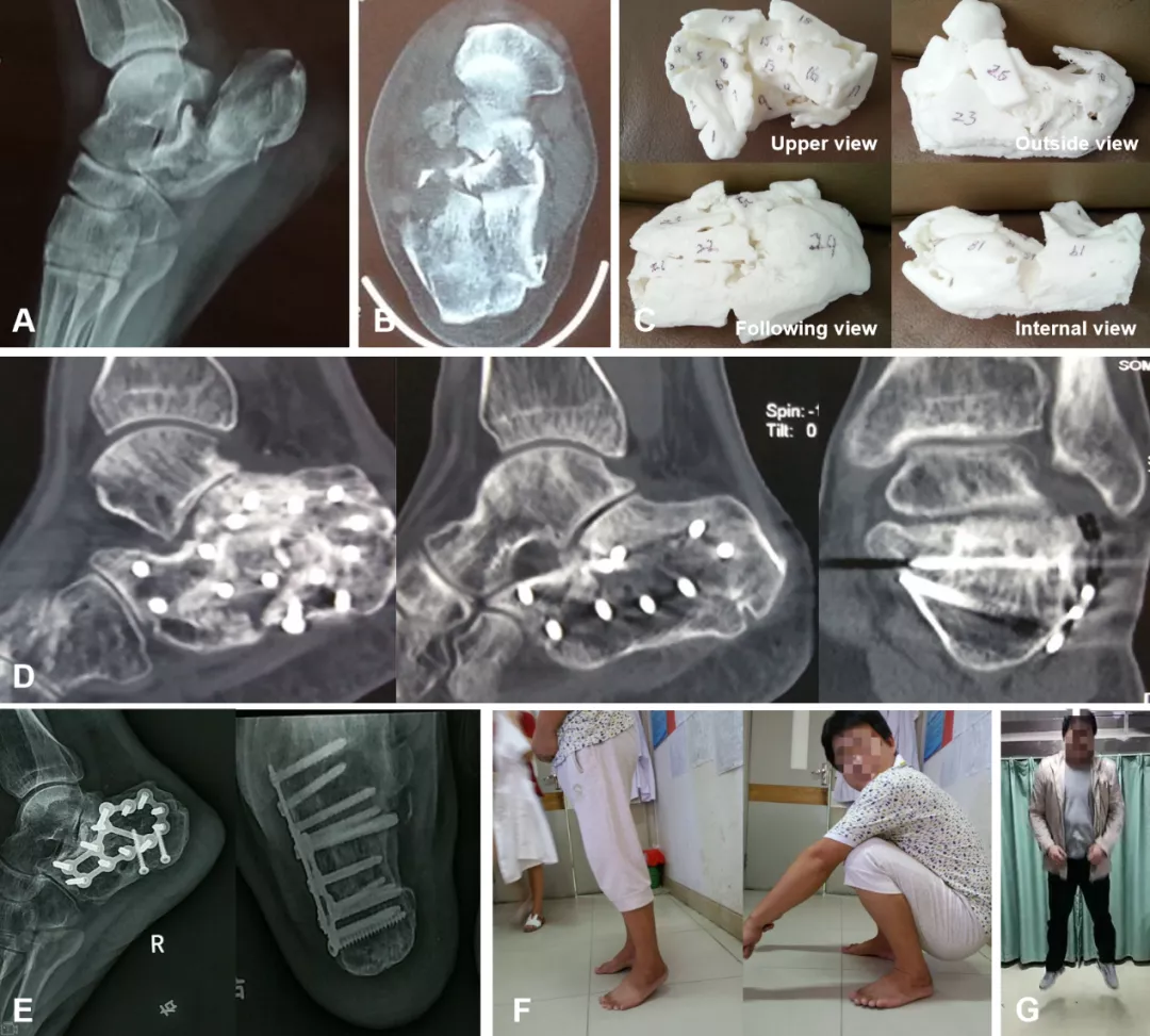 3D打印助力骨科精准临床应用：临床案例解析