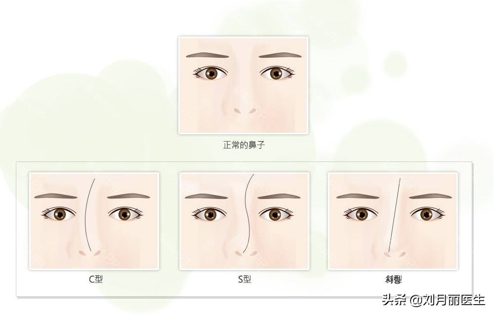 做歪鼻整形手术方法