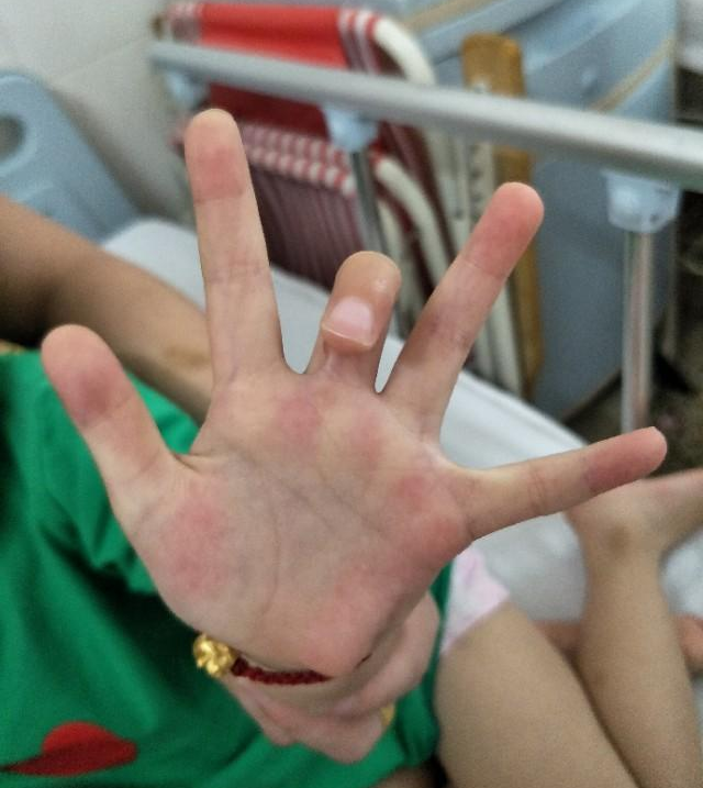 宝宝大拇指蜷着不能伸直,得了腱鞘炎除了手术还有什么方法吗?