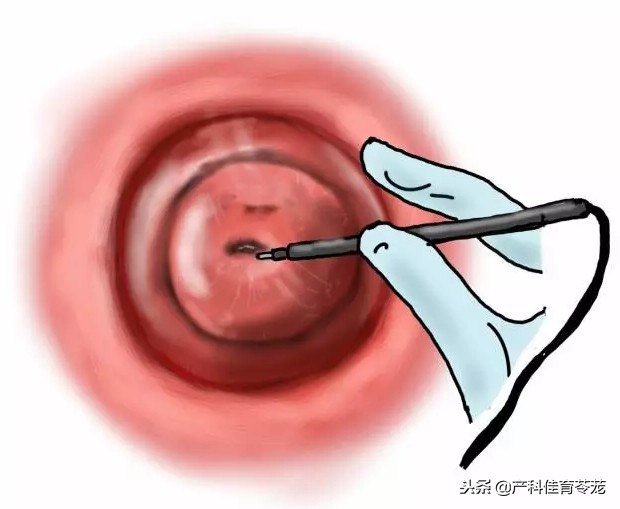 纳囊是什么妇科病(囊肿之宫颈纳氏囊肿) - 百百科