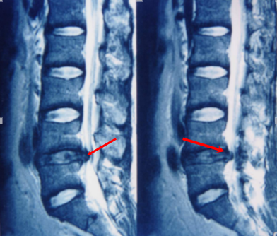 腰椎疾病、腰椎间盘突出你想知道的事全集！