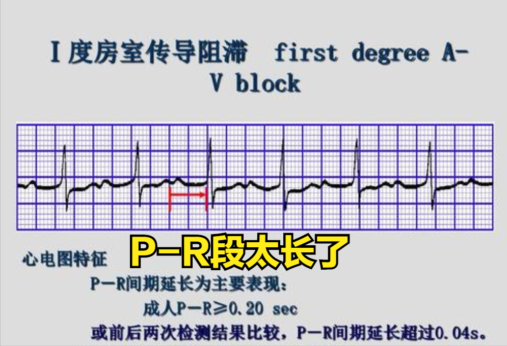 普通人怎么看心电图？医生说：把图上的线条和心脏的跳动结合起来