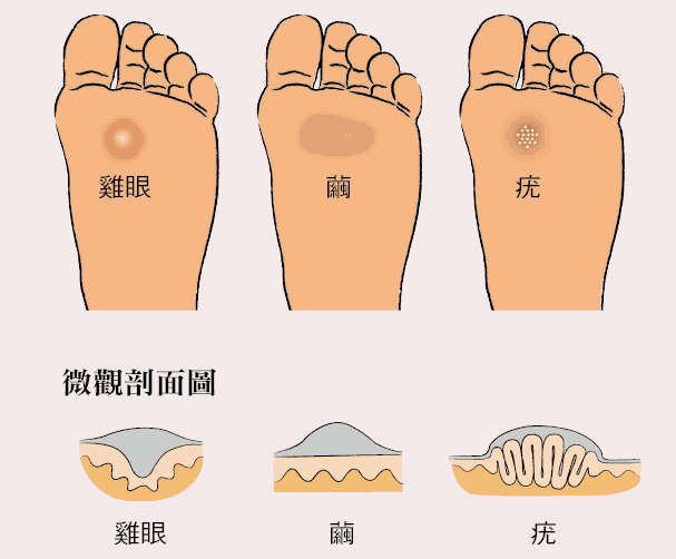 长鸡眼原因图片