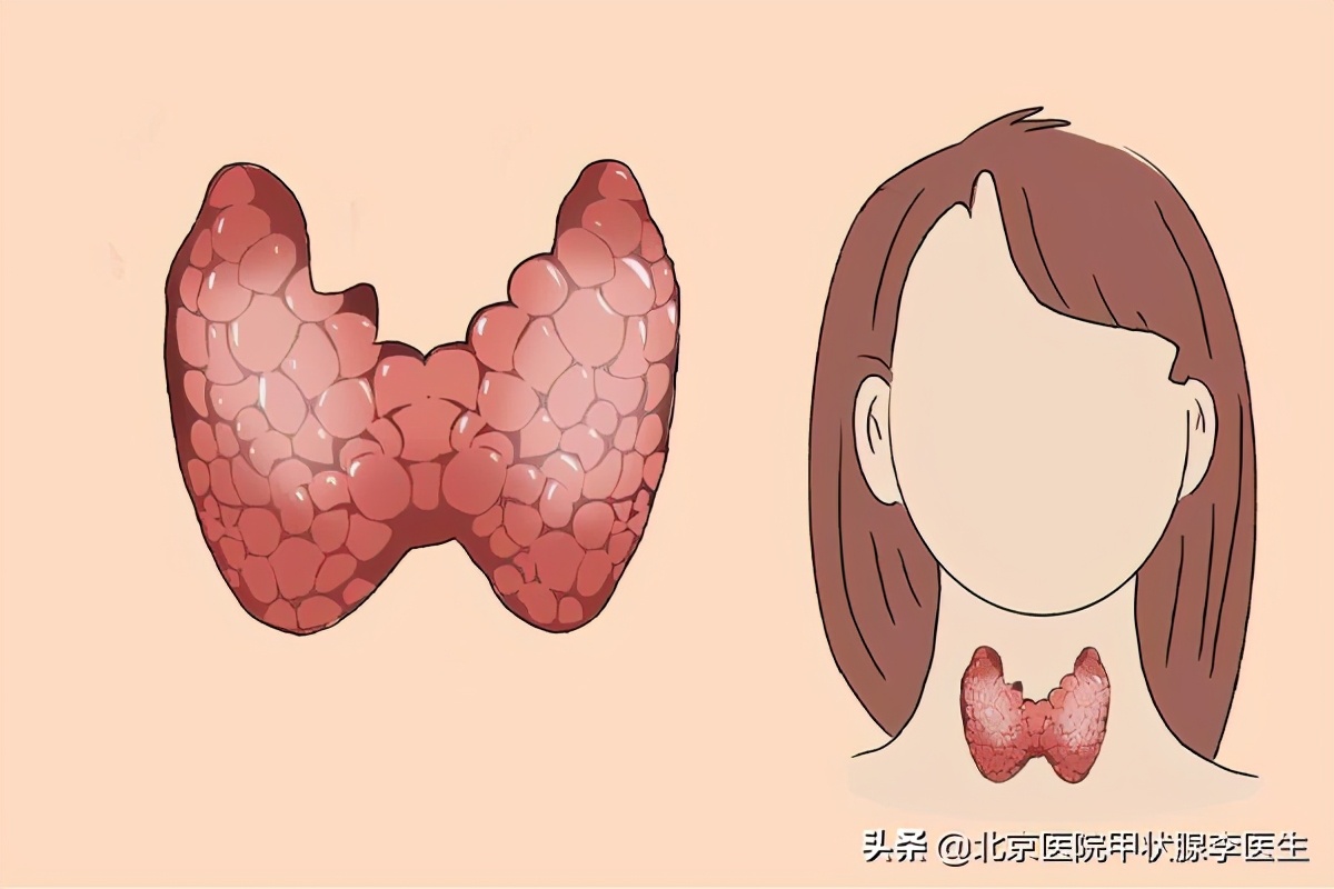 在甲状腺结节的治疗过程中，该不该开刀？手术切除有什么弊端？