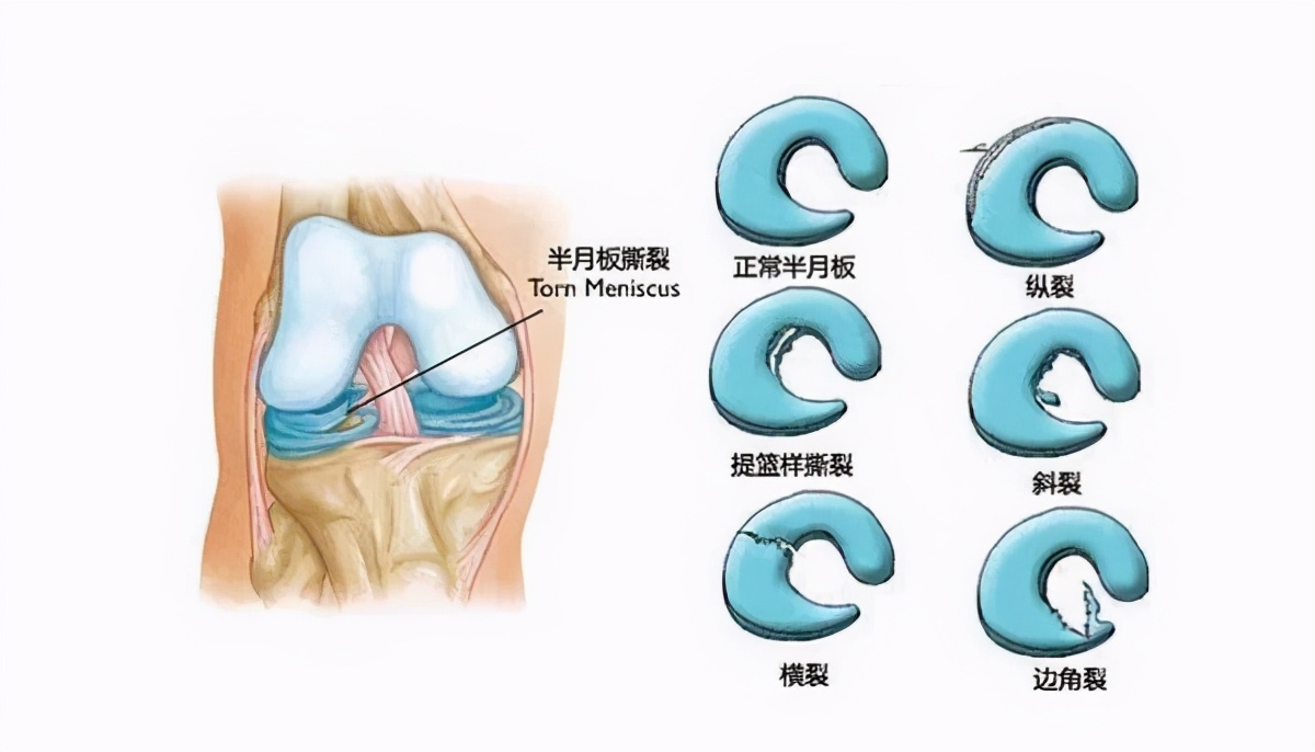 踢完足球膝盖疼是怎么回事(欧洲杯激战，这5种常见的足球运动损伤你不可不知)