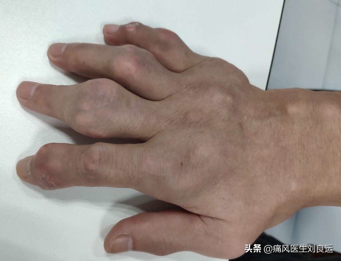 治痛风用药降尿酸需定期做什么检查？六项指标及时发现肾脏问题