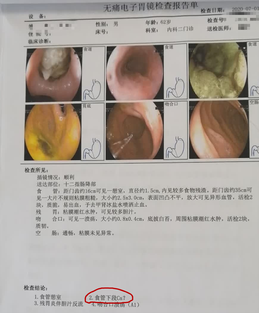 剑突与食道癌肿瘤的鉴别诊断方法