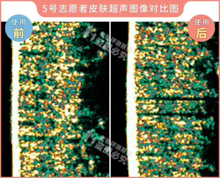 网红家用美容仪真的有效吗？2个多月的跟踪实测结果来了