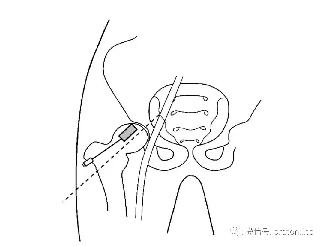 临床实用 | 关节穿刺技术分享