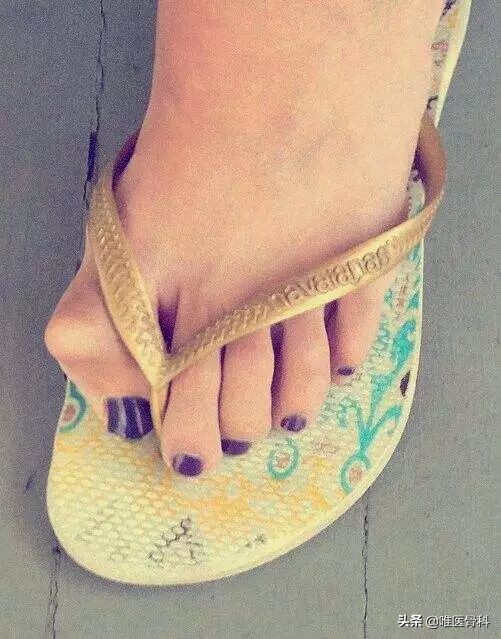 为什么nba脚趾变形（詹姆斯的拇外翻-光芒背后有多少疼痛你永远不懂）