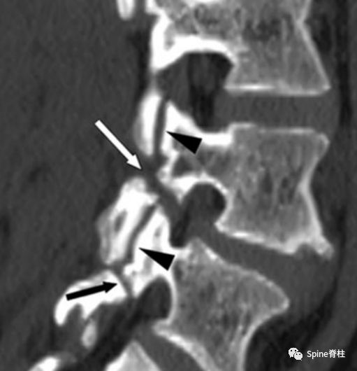 从诊断到治疗：全面解析腰椎峡部裂(lumbar spondylolysis)