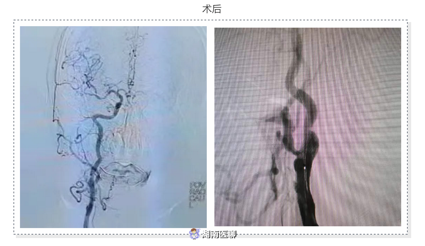 什么是颈动脉支架植入术？哪些人适合做？答案都在这了