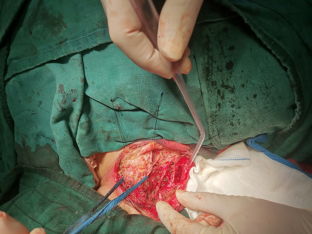 淋巴结核传染吗 脖子淋巴结核传染给别人吗-千百号