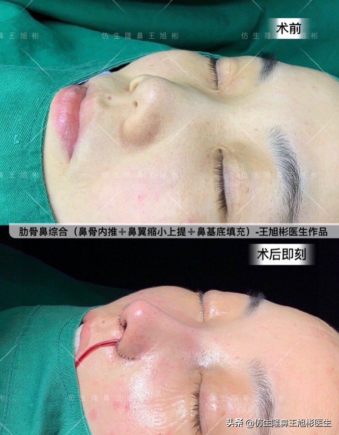 如何定义短鼻，短鼻延长后的改变有多大？