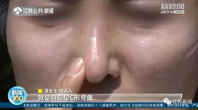 女子鼻头微微右偏，花3万整形后更难受了：鼻子整个朝左歪，鼻孔还不对称