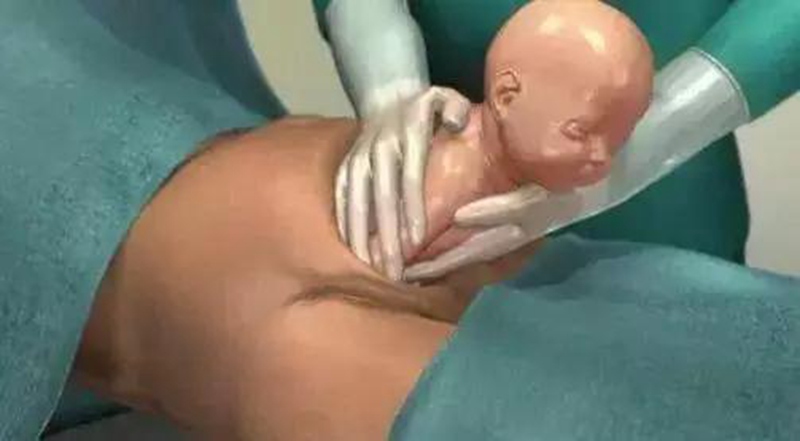 一组图带你了解剖腹产的整个过程：每位产妇都是超人，老公该看看