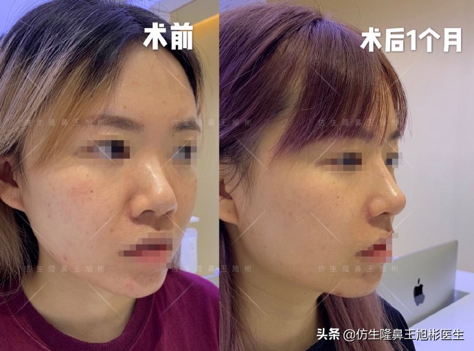 如何定义短鼻，短鼻延长后的改变有多大？