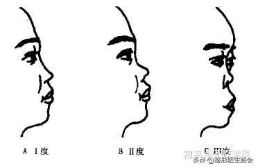 鞍鼻原来就是塌鼻梁？之前了解太少了