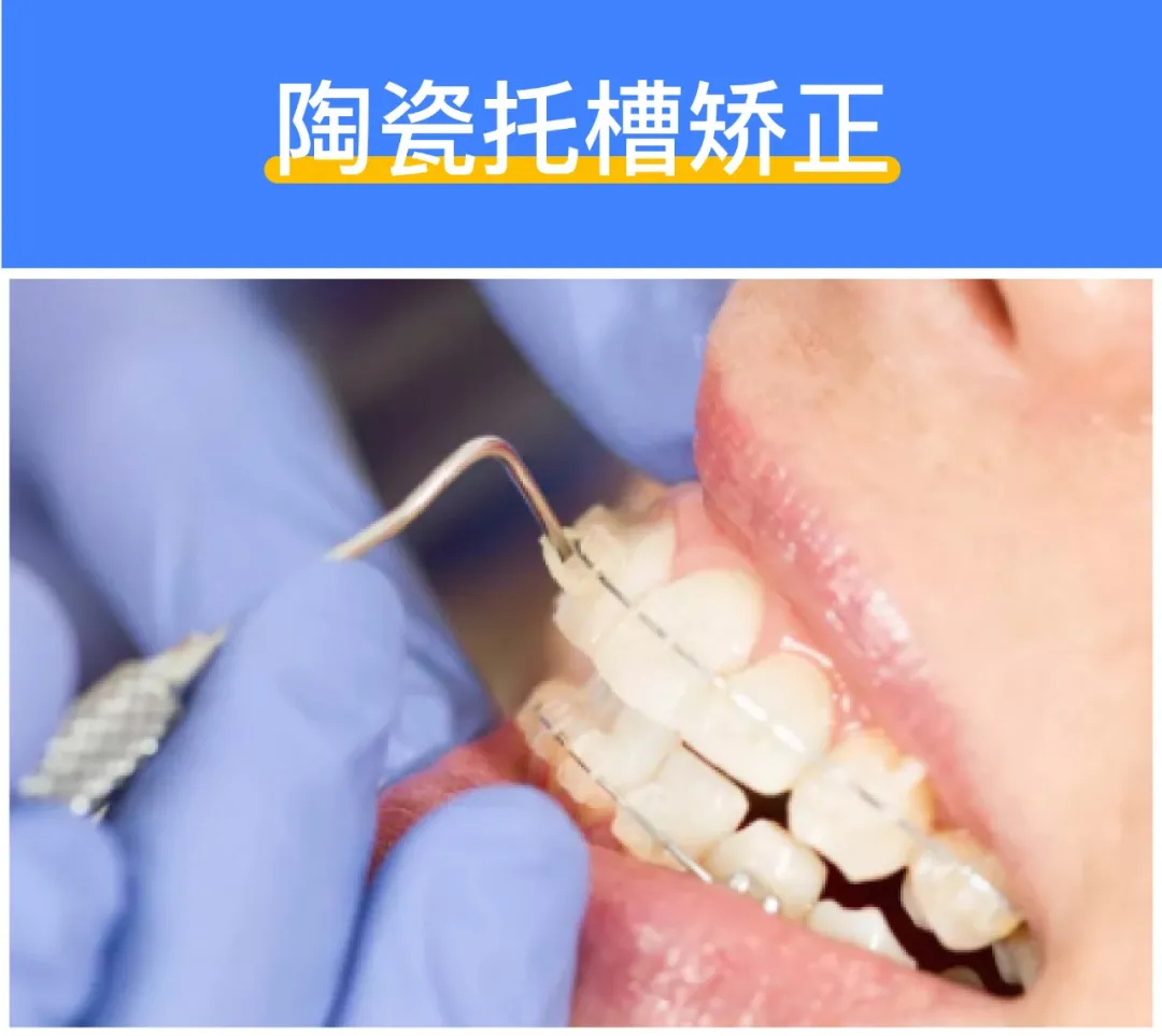 深度揭秘:牙齿矫正到底需要多少钱?
