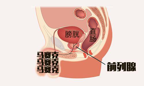 一般前列腺炎治多久才好？分急性、慢性前列腺炎2种情况