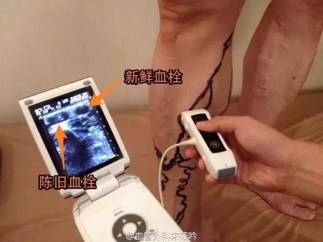 不踩误区！血栓性浅静脉炎的正确治疗方式与时机