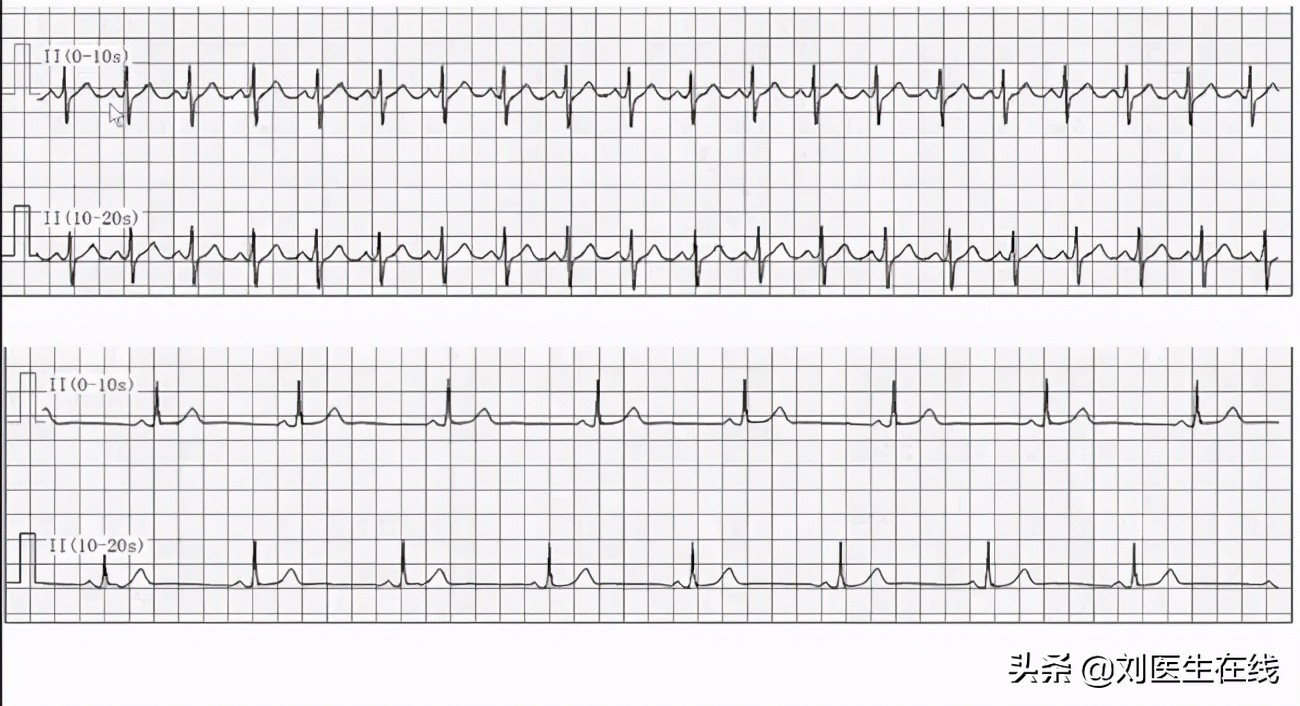 55岁王阿姨长期吃阿司匹林，却脑梗复发，医生心脏听诊找到了原因