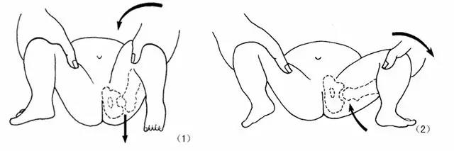 辟谣 I 孩子臀纹不对称，就是髋关节发育不良。医生：还真不是