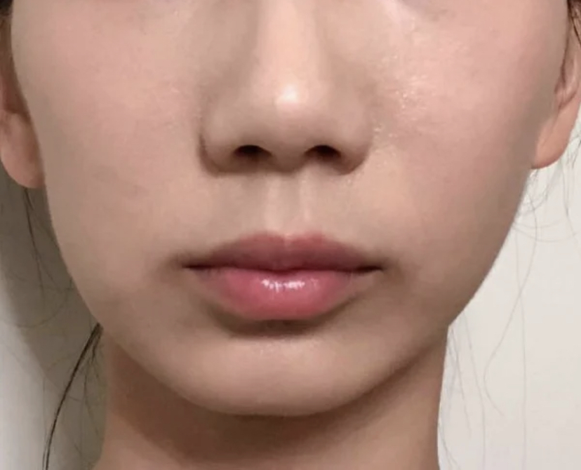 “大小脸”会影响颜值，来看看是怎样改善的，越早知道越好