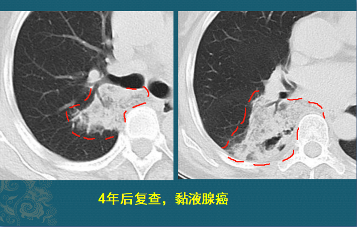 这个肺结节，从8mm发展到晚期肺癌，用了9年