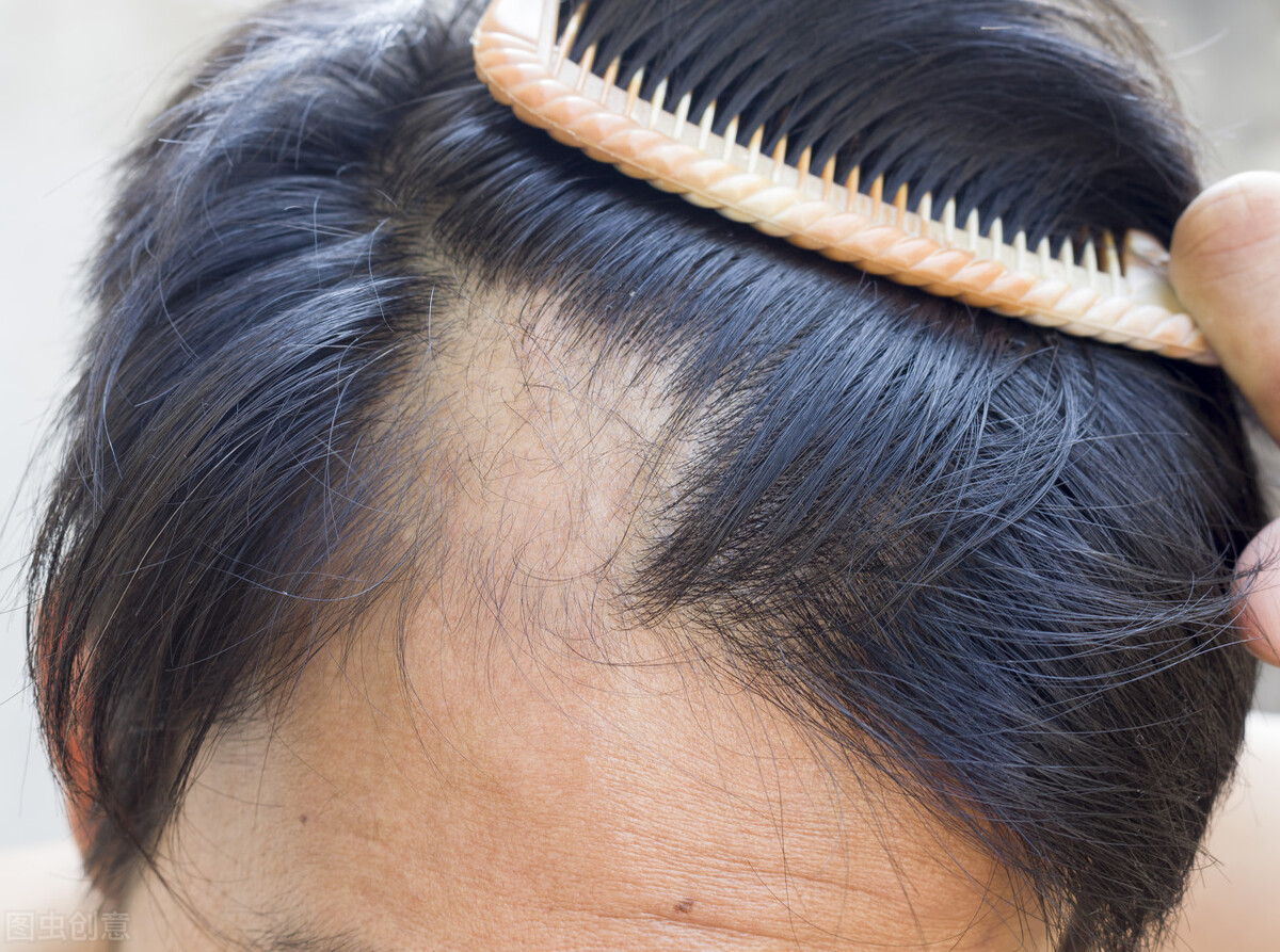 脱发人士必看：拯救发量的N个办法，到底哪个最靠谱？