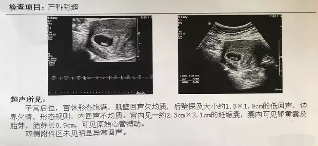 怀孕50天左右彩超单上写什么？这个男孩彩超单，5大数据一看就懂