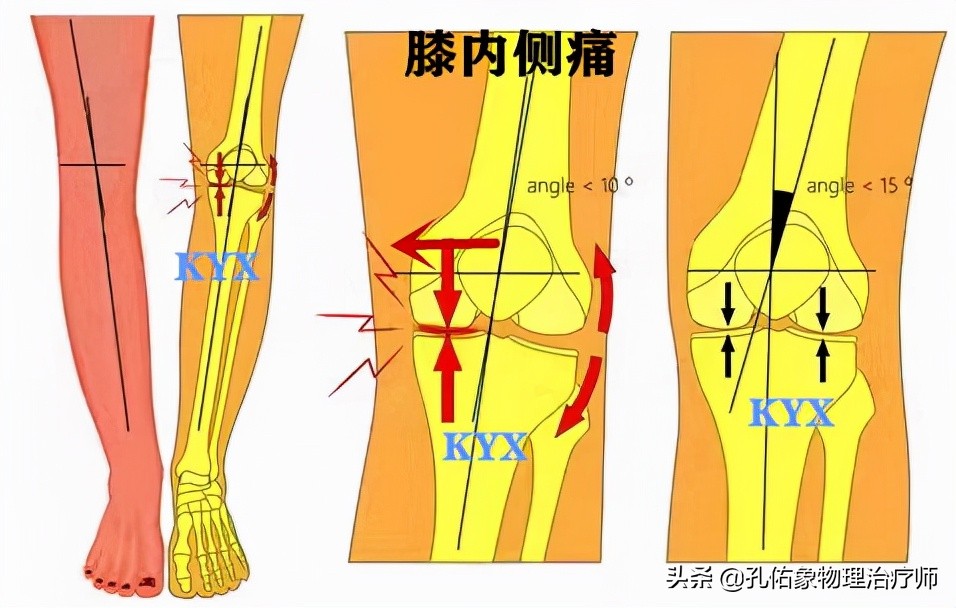 老年人下蹲、上下楼梯困难，膝关节疼痛，是膝关节骨性关节炎吗？