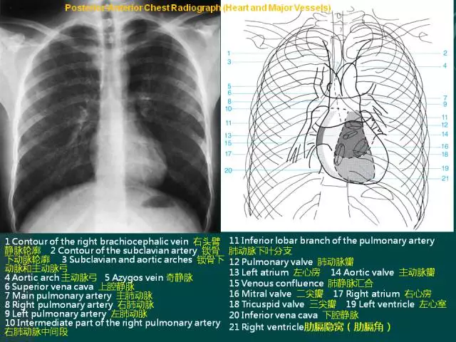 纵隔解剖 + 纵隔疾病X线诊断要点