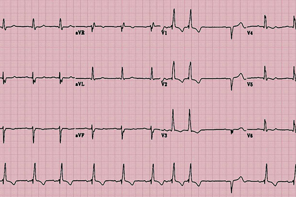 心电图中st改变是什么意思「心电图中st改变心脏彩超正常」