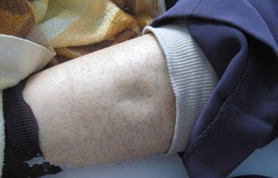 脚脖子水肿是怎么回事如何解决「脚脖子水肿了怎么快速消肿」-友友