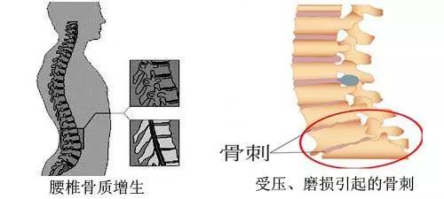 什么“骨刺”，我该怎么处理