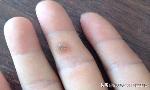 疣是什么样子图片 hpv疣状物长什么样-百联百科