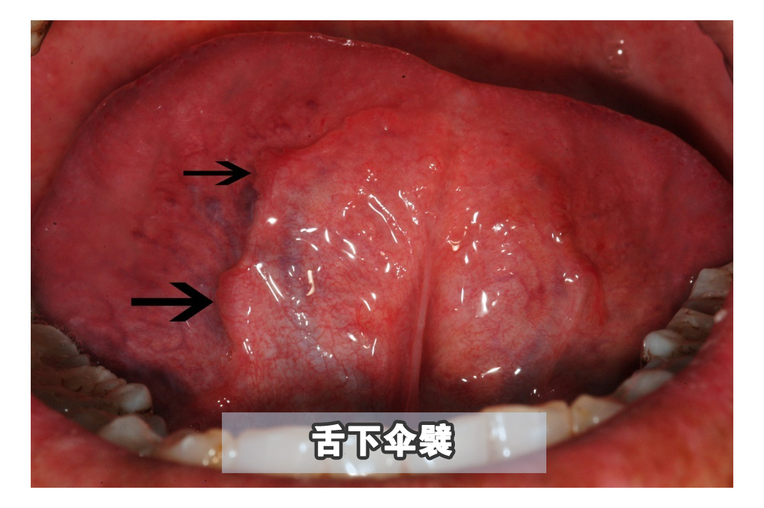 嘴里长了可怕的“肉揪”，真的不是口腔癌吗？