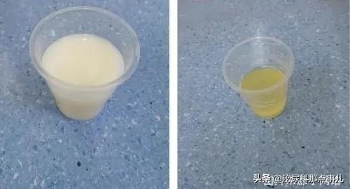 乳糜尿的临床诊治